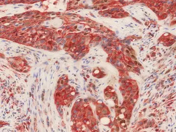 Biopsia de un tumor oral Biopsia de un tumor oral