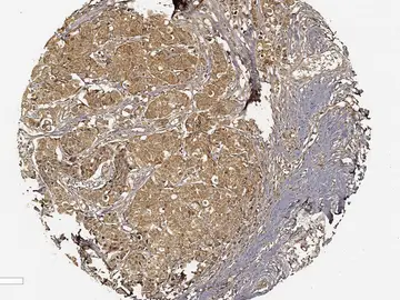 Identifican una nueva diana terapéutica contra el cáncer de mama Identifican una nueva diana terapéutica contra el cáncer de mama