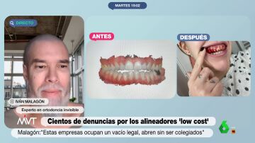 El experto Iván Malagón advierte del peligro de los alineadores dentales 'low cost': "Se te pueden llegar a caer los dientes"