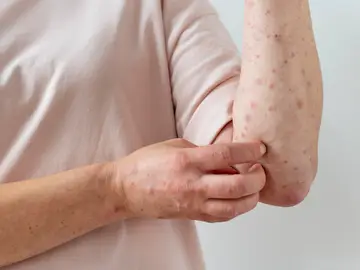 Mujer con sarampión Mujer con sarampión
