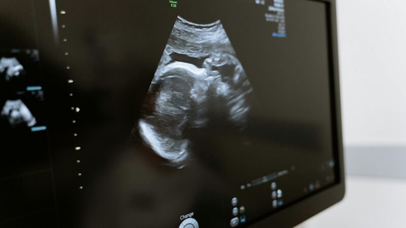 ¿Existe el síndrome post aborto? Esto es lo que dice la ciencia