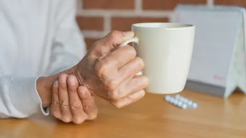 Manos temblorosas por el Parkinson Manos temblorosas por el Parkinson