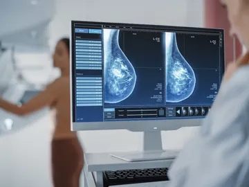 mamografía, cáncer de mama. mamografía, cáncer de mama.