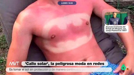 Iñaki López alucina con el reto viral de hacerse 'tatuajes' con las quemaduras solares Además del 'callo solar', la última y peligrosa tendencia en redes, también existen retos virales donde hay quien se hace 'tatuajes' a partir de las quemaduras solares. Algunos ejemplos, como la 'Gioconda' o el símbolo de Batman, en este vídeo.