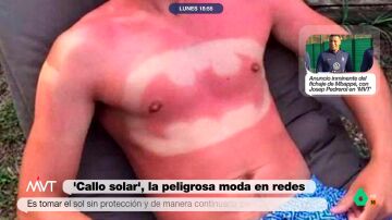 Iñaki López alucina con el reto viral de hacerse 'tatuajes' con las quemaduras solares