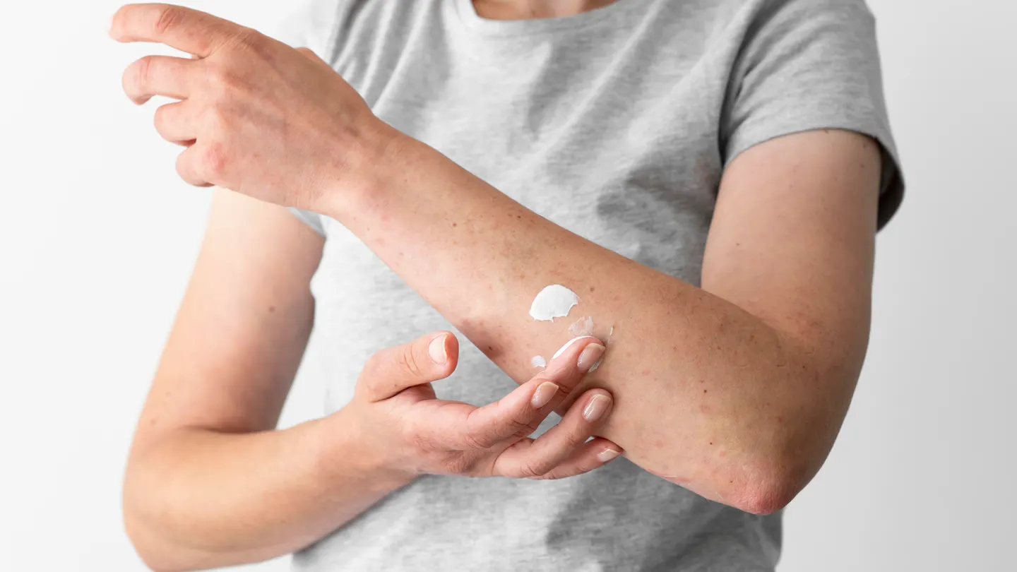 Una persona con un posible brote de dermatitis en su piel. Una persona con un posible brote de dermatitis en su piel.