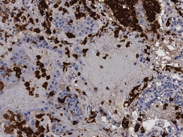 Macrófagos en pulmones con covid-19