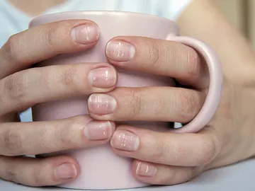 Uñas con manchas blancas Uñas con manchas blancas