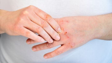 Manos con heridas causadas por el frío