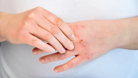 Manos con heridas causadas por el frío Manos con heridas causadas por el frío
