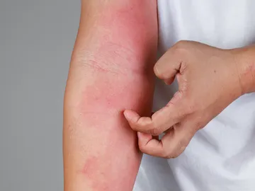 Urticaria Urticaria