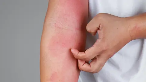 Urticaria Urticaria