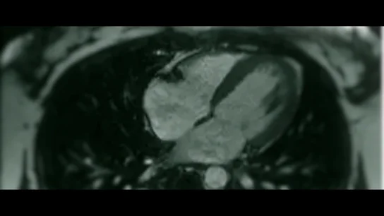 Así es la embolia gaseosa masiva, el método del 'ángel de la muerte' en el hospital para inyectar aire en las pacientes Así es la embolia gaseosa masiva, el método del 'ángel de la muerte' en el hospital para inyectar aire en las pacientes