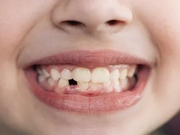 Sonrisa sin un diente Sonrisa sin un diente