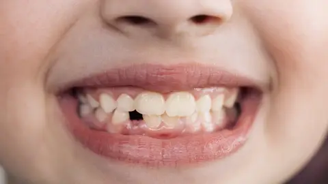 Sonrisa sin un diente Sonrisa sin un diente