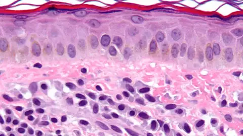 mastocitosis mastocitosis