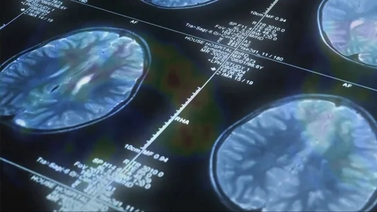 Qué es el linfoma cerebral, el tipo de cáncer que tiene Raphael Qué es el linfoma cerebral, el tipo de cáncer que tiene Raphael
