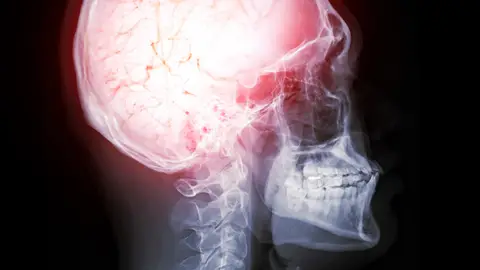 Cerebro humano Cerebro humano