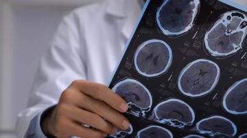 Detectan cambios en regiones cerebrales clave en el alzheimer en individuos con alta carga patologica en sangre