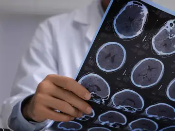 Detectan cambios en regiones cerebrales en individuos con alzheimer y alta carga patologica Detectan cambios en regiones cerebrales en individuos con alzheimer y alta carga patologica