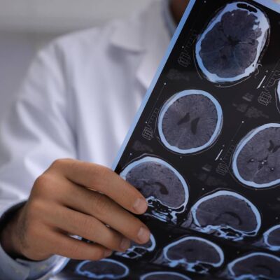 Detectan cambios en regiones cerebrales en individuos con alzheimer y alta carga patologica