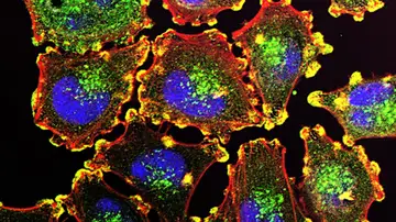 Células cancerosas Células cancerosas