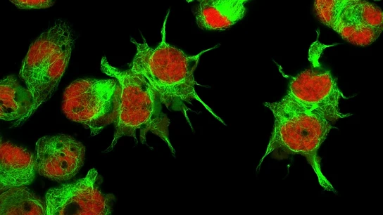 Vista al microscopio de células de neuroblastoma, en una imagen de archivo. Vista al microscopio de células de neuroblastoma, en una imagen de archivo.