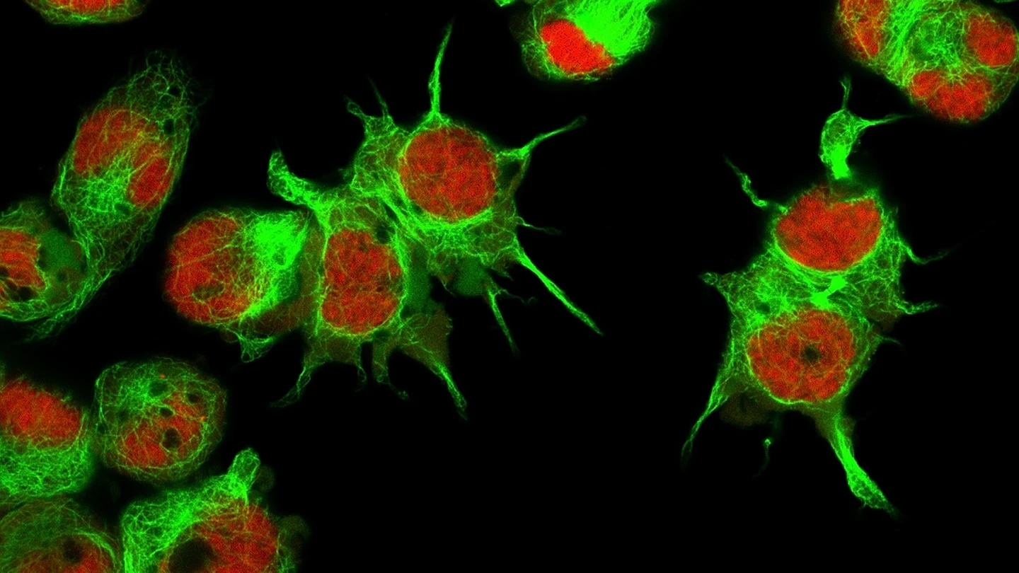 Vista al microscopio de células de neuroblastoma, en una imagen de archivo. Vista al microscopio de células de neuroblastoma, en una imagen de archivo.