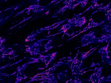 Un defecto en el transporte de grasas revela la causa de las raras crisis metabolicas infantiles Un defecto en el transporte de grasas revela la causa de las raras crisis metabolicas infantiles