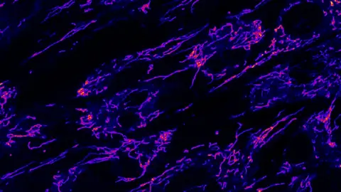 Un defecto en el transporte de grasas revela la causa de las raras crisis metabolicas infantiles Un defecto en el transporte de grasas revela la causa de las raras crisis metabolicas infantiles