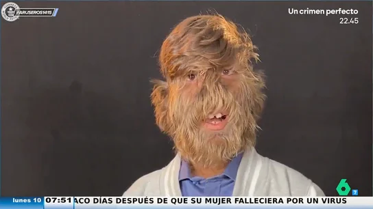 Así es la persona más peluda del mundo que ha batido el récord Guinness con tan solo 18 años Así es la persona más peluda del mundo que ha batido el récord Guinness con tan solo 18 años