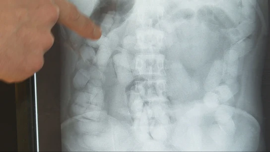 Intestino lleno de bolas de un 'bolero' Intestino lleno de bolas de un 'bolero'