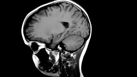 TAC del cerebro TAC del cerebro