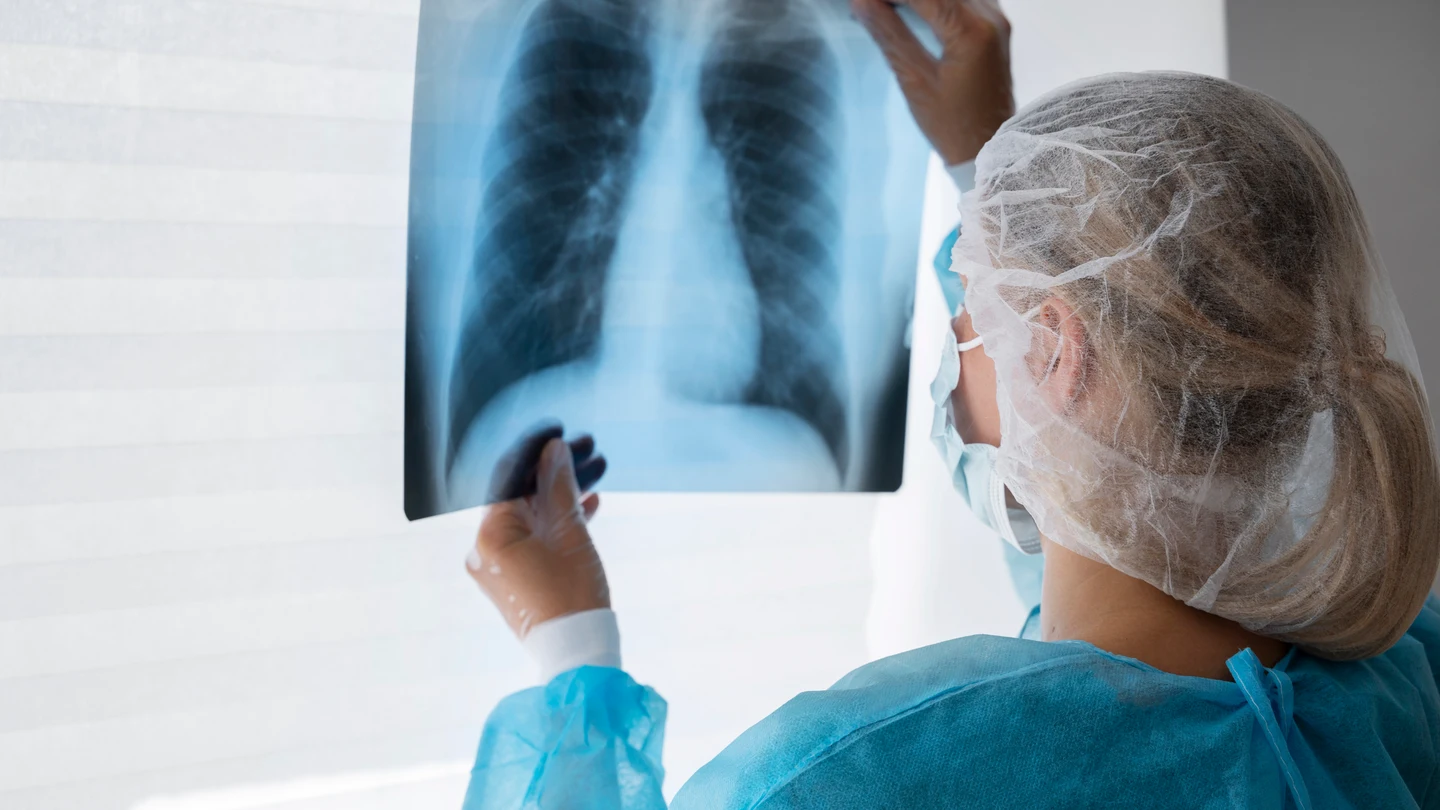 Una radiografía de pulmón Una radiografía de pulmón - silicosis