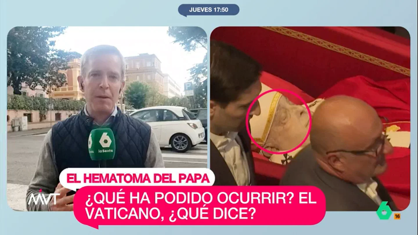 ¿Por qué el papa Francisco tiene un moratón en la frente? ¿Por qué el papa Francisco tiene un moratón en la frente?