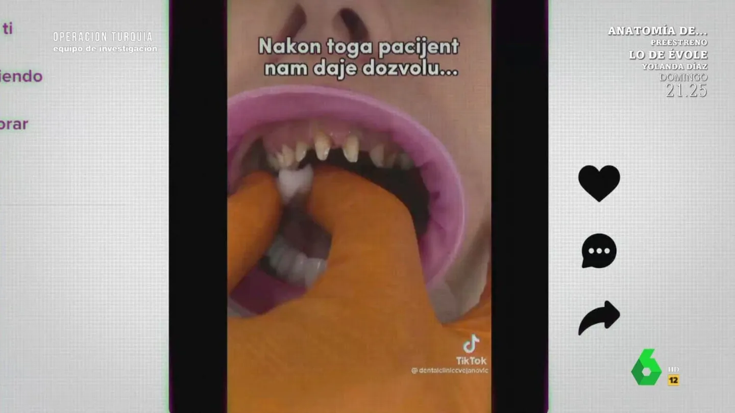 La 'sonrisa de Hollywood', la moda de sustituir todos los dientes por coronas. La 'sonrisa de Hollywood', la moda de sustituir todos los dientes por coronas.