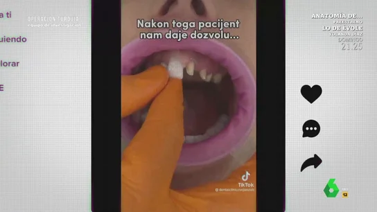 "Una salvajada": el tajante veredicto de un dentista sobre la moda de sustituir todos los dientes por coronas "Una salvajada": el tajante veredicto de un dentista sobre la moda de sustituir todos los dientes por coronas