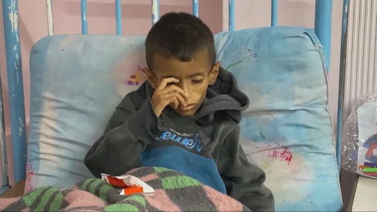 Un niño gazatí, completamente desnutrido Un niño gazatí, completamente desnutrido