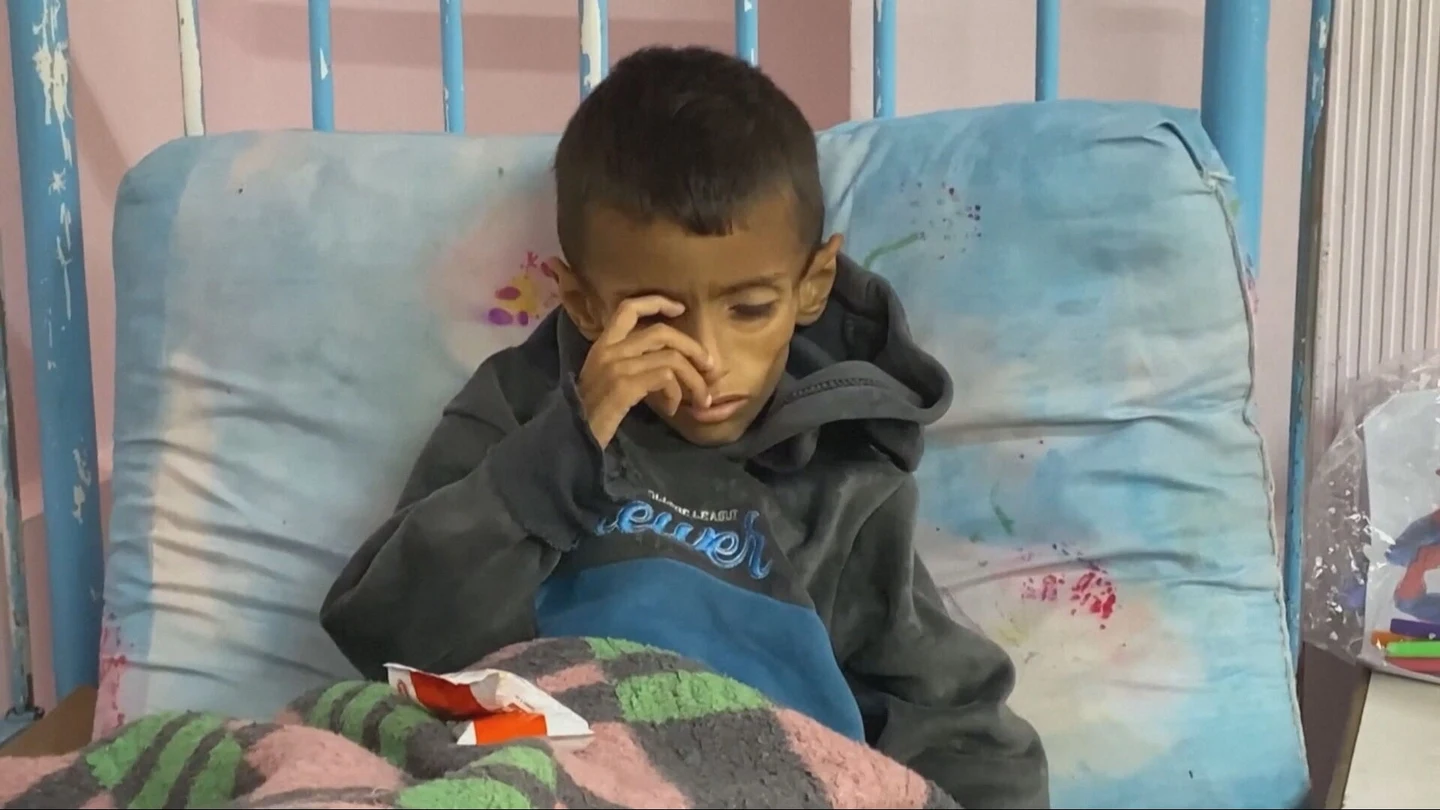 Un niño gazatí, completamente desnutrido Un niño gazatí, completamente desnutrido