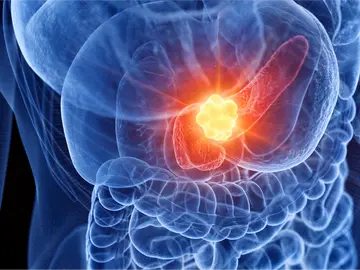 Cáncer páncreas Cáncer páncreas