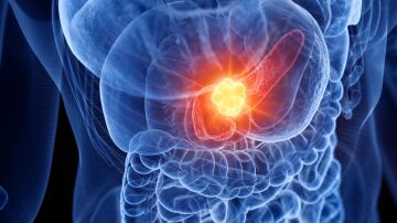 Cáncer páncreas