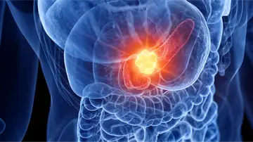 Cáncer páncreas Cáncer páncreas