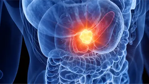 Cáncer páncreas Cáncer páncreas