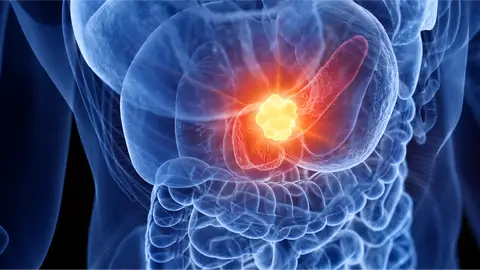 Cáncer páncreas Cáncer páncreas