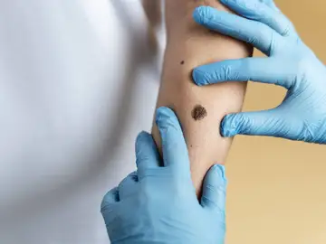 Inmunoterapia, el tratamiento clave contra los melanomas Inmunoterapia, el tratamiento clave contra los melanomas