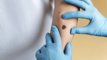 Inmunoterapia, el tratamiento clave contra los melanomas