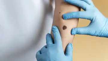 Inmunoterapia, el tratamiento clave contra los melanomas Inmunoterapia, el tratamiento clave contra los melanomas