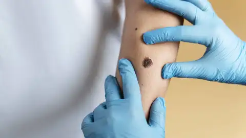 Inmunoterapia, el tratamiento clave contra los melanomas Inmunoterapia, el tratamiento clave contra los melanomas