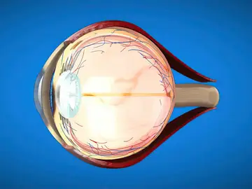 El glaucoma afecta al nervio óptico y a la retina El glaucoma afecta al nervio óptico y a la retina