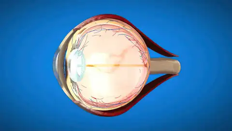 El glaucoma afecta al nervio óptico y a la retina El glaucoma afecta al nervio óptico y a la retina